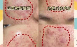 瓷肌祛痘对成人痘效果如何？