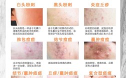 祛青春痘到底有什么好办法？