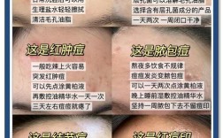 脑门长痘用什么祛痘最有效？