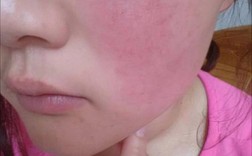 肌美精祛痘面膜过敏怎么办？