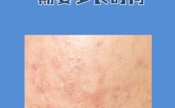 北京激光祛痘哪家医院最靠谱？