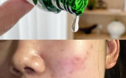 Cici小黑瓶 祛痘