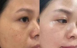 祛斑和祛痘，哪个效果更好？