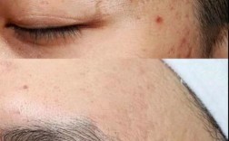 激光祛痘坑祛痘真的安全吗？