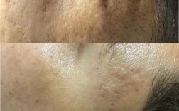 祛痘印、痘坑能一起修复吗？