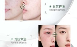 男士祛痘印产品哪个牌子的效果最好？