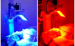 蓝光祛痘的原理是什么？