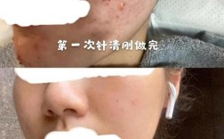 祛痘针挑破痘痘安全吗？