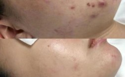 祛痘为何要先排毒再修复？