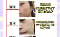 祛痘成功？分享下你的方法！