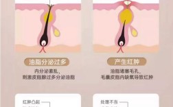 京润祛痘精华正确用法是什么？