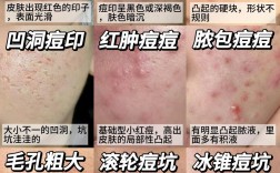 祛痘痘印，到底哪种方法最好？