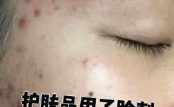 护肤品刺脸是过敏还是刺激？