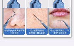 祛痘针挤痘真的有用吗