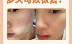 激光祛痘还是祛痘印？效果有何不同？