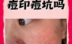 彩光祛痘印有年龄限制吗？