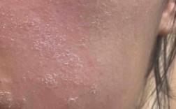 涂抹祛痘药膏全脸蜕皮