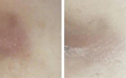 pola局部精华祛痘印真的有效吗？