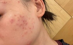 护肤品致痘？脸敏肌怎么选？