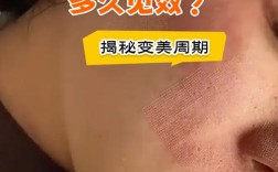 激光祛痘印一般需几次见效？