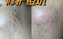 祛痘去中国安徽疤痕王