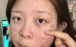 祛痘产品为何反而催生新痘？