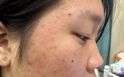 果酸祛痘后效果能持久吗？