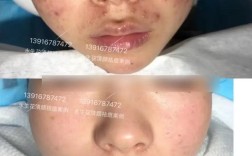 韩后祛痘达人效果到底如何？