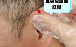 耳朵上放血祛痘的原理