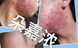 朵嘉浓祛痘到底有没有用？