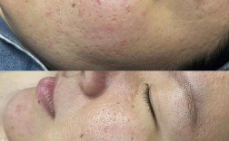 马油祛痘疤真的有效吗？