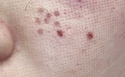 激光祛痘印后为何出现白点点？