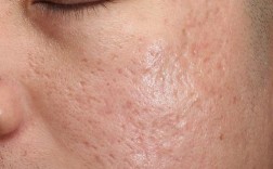 激光祛痘印危险吗？