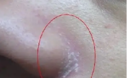 鼻子两侧用护肤品刺痛，为何会这样？