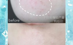 安美拉祛痘软膏效果真的好吗？