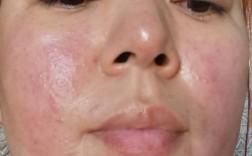 护肤品上脸刺痛是过敏了吗？