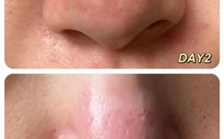 Sampar祛痘效果真的好吗？