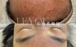 祛痘师和美容师哪个好