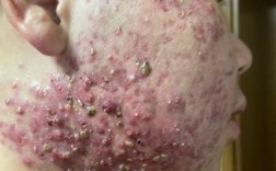 天津武警医院果酸祛痘效果怎么样？