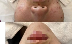 nakeup face祛痘印真的有效吗？