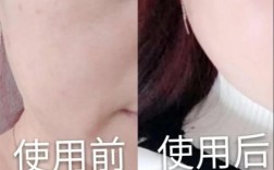 VC原液能祛痘印吗？效果如何？