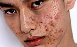 男生祛痘该用什么洗脸？