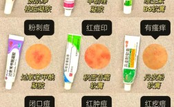 男士祛痘最好产品是哪款？