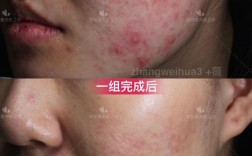 Vidivici祛痘效果真的好吗？