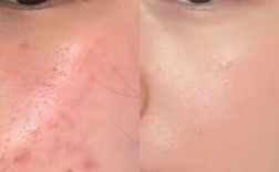 酸奶涂脸能祛痘印吗？