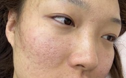 激光祛痘坑真没效果吗？