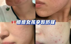 吃胶原蛋白真能祛痘坑吗？