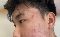 男士祛痘效果最好的方法是什么？