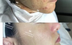 老中医祛痘真的有效吗？