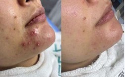 祛痘洗面奶反而爆痘？